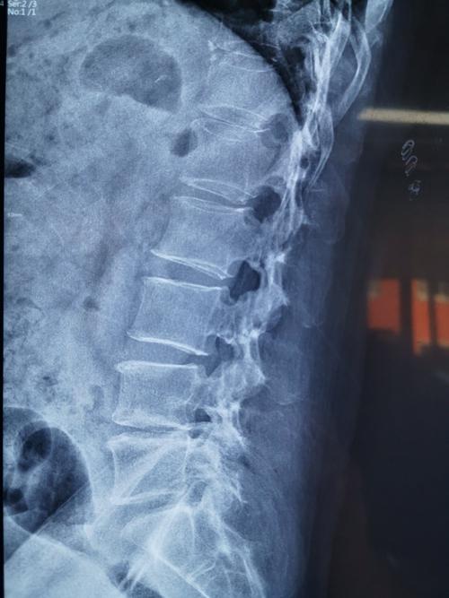今日再为一例l45椎间盘突出并椎管狭窄间隙丢失的患者行内镜下减压