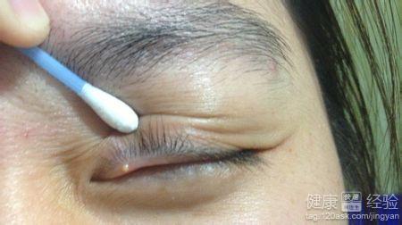 麦粒肿初期怎么办