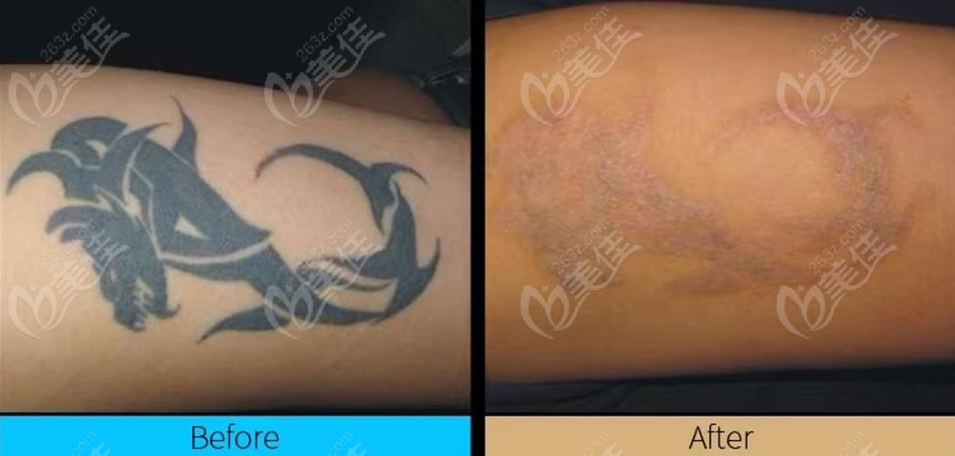 蜂巢皮秒洗纹身真实效果图