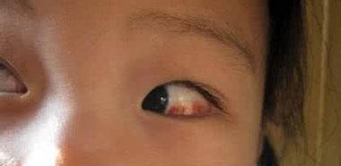 眼部一旦被感染后,局部有异物感,疼痛,瘙痒等症状.如果不