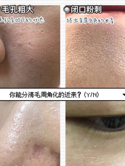 脸上密密麻麻的小疙瘩要及时处理毛周角化我要和你