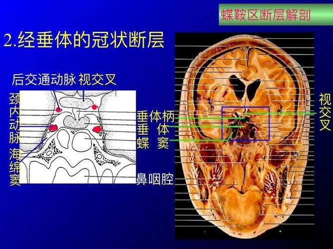 实用课件鞍区解剖资料