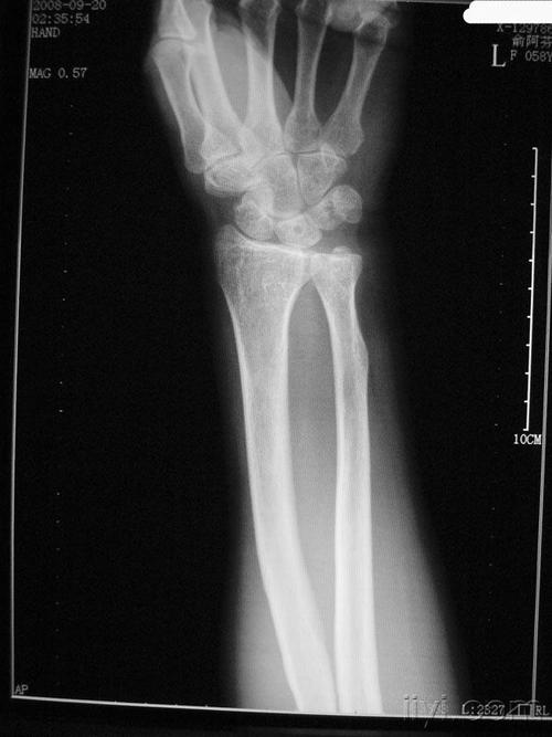 少见下尺桡关节掌侧脱位二例