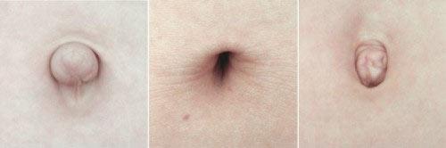 从肚脐眼10个形状看健康