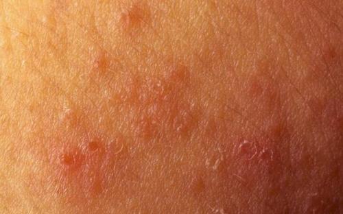 而在湿疹的影响下皮肤就会起