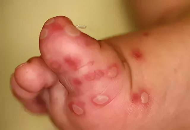 孩子得了手足口病,为啥指甲还脱落了?