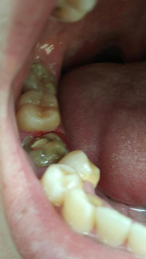 烂牙根就放在哪里不管会怎么样.