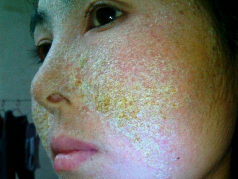 激素脸的症状,使用什么样的化妆品容易得激素脸?