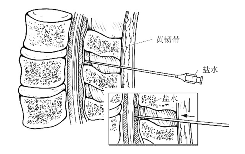 经硬膜外腔镇痛技术