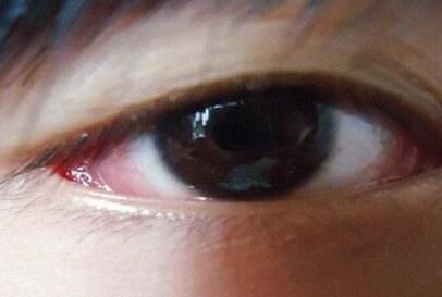 [儿童角膜炎的症状]谨防小儿病毒性角膜炎