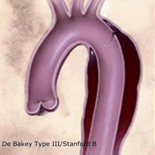 bentall"s联合全弓置换及血管内支架象鼻手术