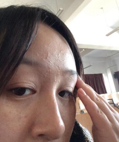 脸上有螨虫怎么办?3个天然招术直捣螨虫窝