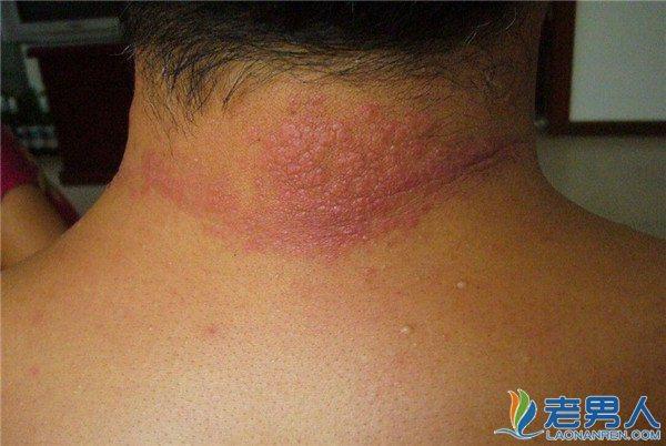 正文  西医治疗:西医治疗紫外线过敏,一般给予抗过敏药,缓解过敏症状