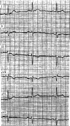第三节 不稳定型心绞痛-冠心病心电图-医学