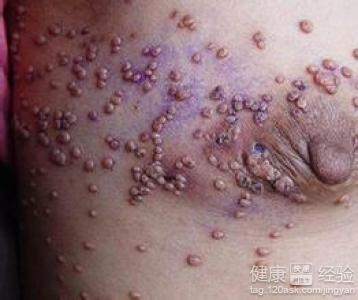 艾滋病一般多久发病