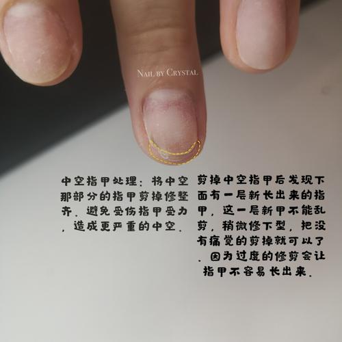 指甲中空:外力引起的指甲受伤,令到指甲和甲床分离(伤口不大时),正常