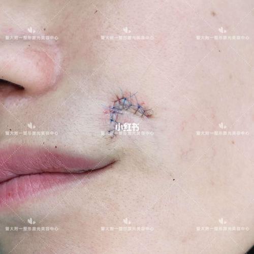 【4种最有效手术治疗疤痕方法】 1,疤痕切除缝合:是治疗疤痕中常用的