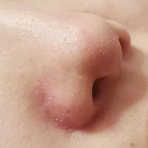 用完清洁面膜鼻子上很多白头怎么办?