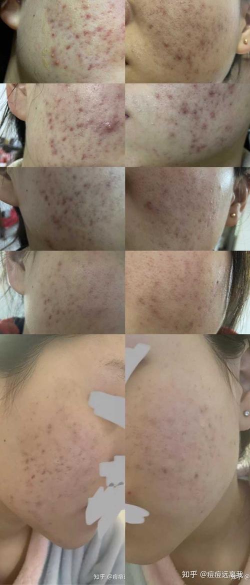 我的痘痘越来越多了而且痘印都黑色素沉淀了,有没有好