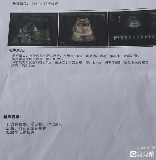 nt归来,nt值是好的,不过胎盘低置状态