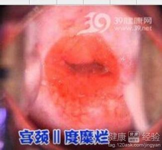 宫颈糜烂用药后为何白带会出现血丝