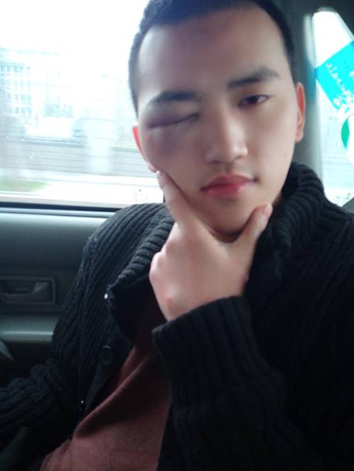 男朋友昨晚喝多了,进了医院,今天去看他接他回家,眼睛给肿成这样了,睁
