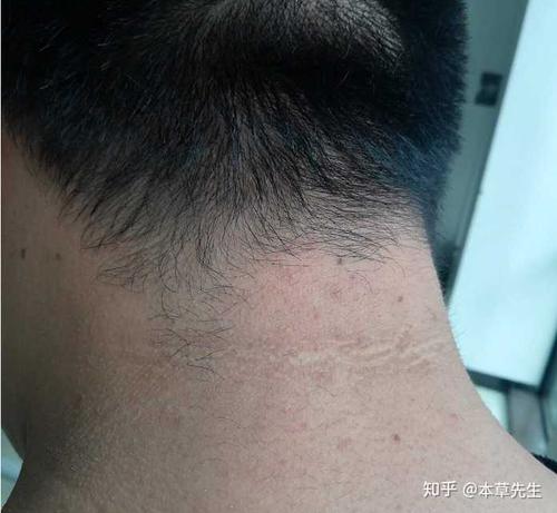 脖子腋下和大腿根皮肤黑,是病么?能治么?