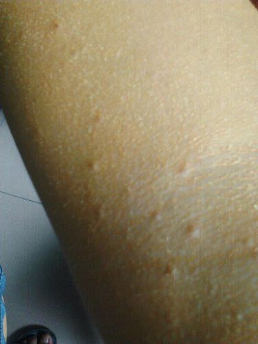 医生救命啊 看看这是什么病?特别是热的时候和晚上特别痒,怎么治啊