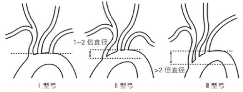 第一期南部战区总医院神经外科脑病中心小讲堂-主动脉弓分型及意义