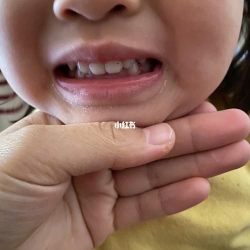 孩子吃嘴到变形的问题|终于算解决了!_母婴_育儿_母婴