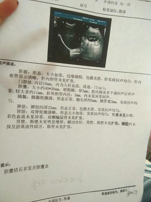 胆囊里有四个石头,超声提示:胆囊结石多发并胆囊炎