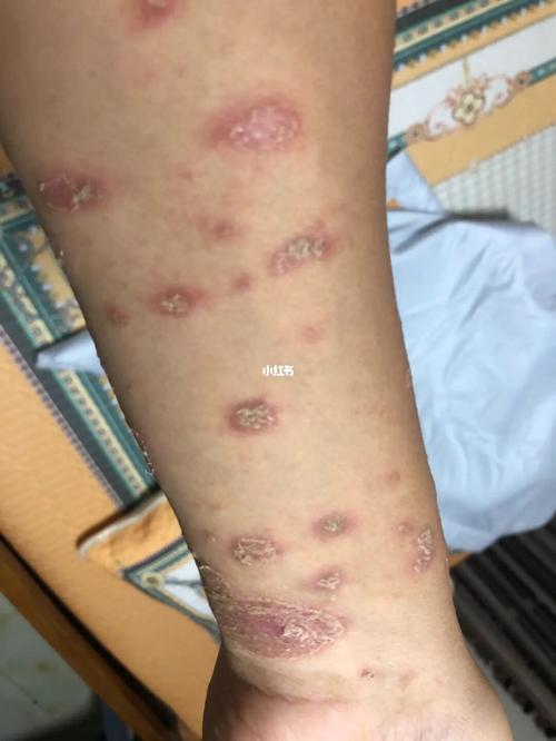 医院确诊为玫瑰糠疹_玫瑰糠疹_医疗健康_医疗健康其他
