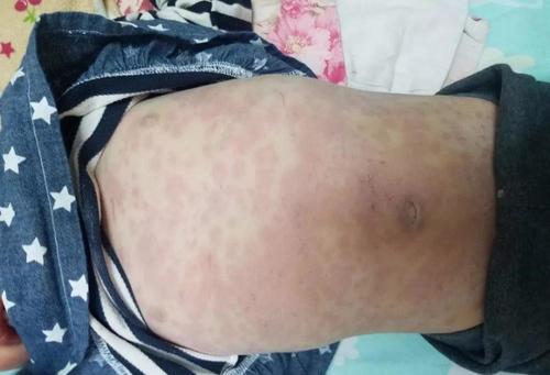 皮肤表现: 多形性红斑或猩红热样,麻疹样皮疹,常在第1周出现.