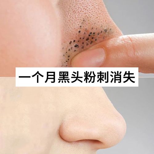 去黑头粉刺水湿敷鼻子除螨虫白头黑头导出液单瓶收缩毛孔精华液女