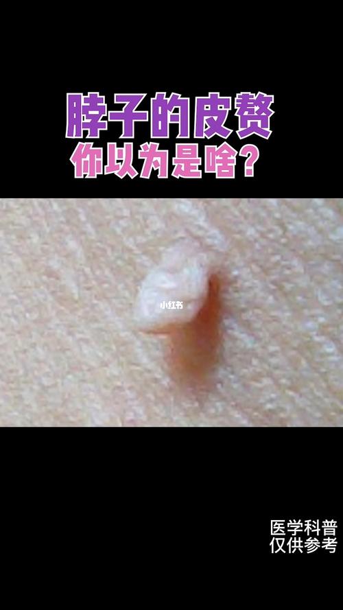 脖子的皮赘,你以为是啥?_皮肤_美妆_护肤