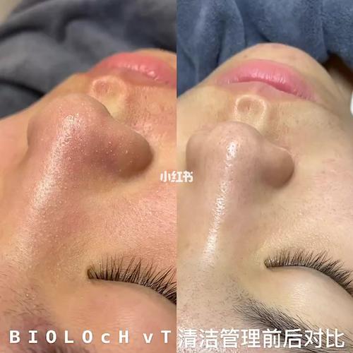 碧洛诗清洁管理去黑头前后对比_去黑头_清洁_深层清洁