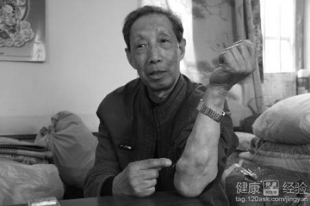 多发生在皮下,往往外面会包有结缔组织包囊,这种疾病的症状就是"肉瘤"