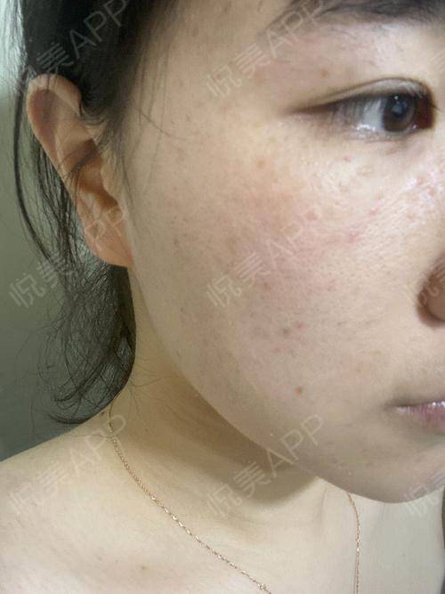 皮秒激光术后7天_祛斑术后7天_皮肤美容术后7天_兰兰分享图片3