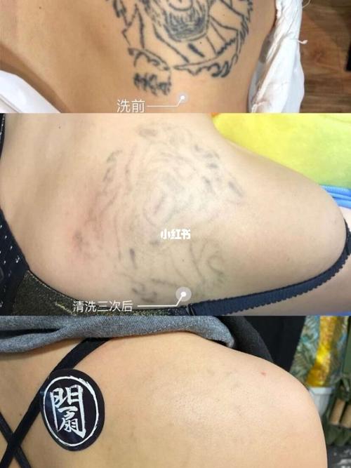 天津客人四次超低温皮秒洗纹身效果分享