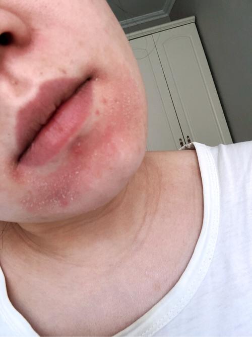 孕妈们有下巴长癣的吗