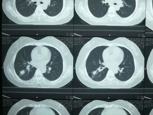 陈旧性肺结核钙化灶,一年半复查明显变小