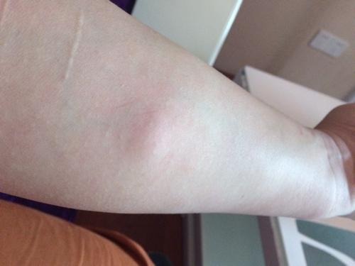 分享到:  2014-10-15 12:07 提问者采纳  热心网友 筋包(脂肪瘤)