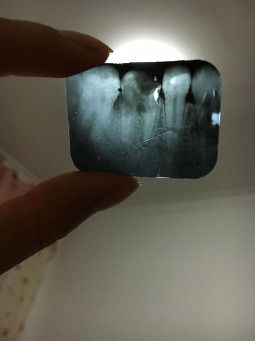 今天去医院拍了个六龄牙牙片,医生说牙根不行了,要拔掉再做治疗,我看