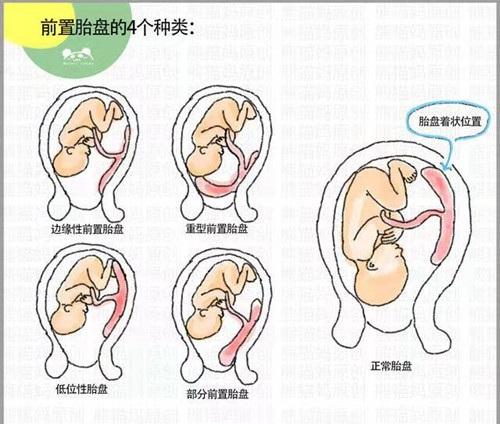 根据与宫颈内口的位置关系,前置胎盘可以分为四种类型:    低置胎盘