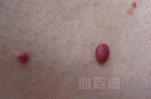 肉芽肿型毛细血管瘤严重吗?怎样治疗?