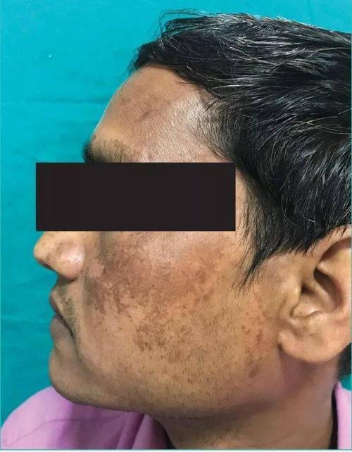 被忽视的男性黄褐斑你了解多少