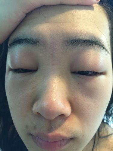 眼睛海鲜过敏,肿,懂的来,谢谢.