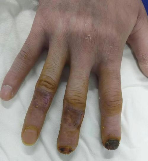 手指末端缺损修复!