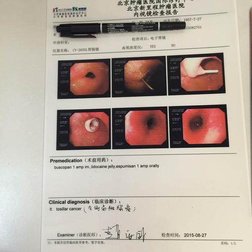 peg为患者解决吃饭问题成功完成首例经皮内视