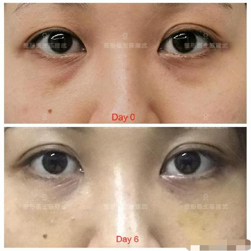 24岁美女内切眼袋后眼袋和泪沟改善明显
